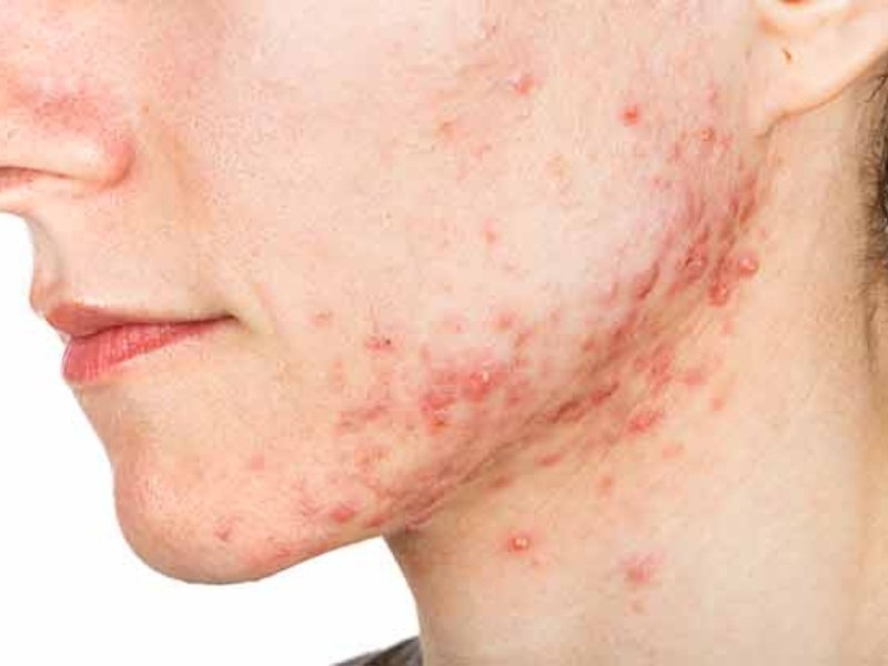 Acne Consultation Form